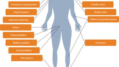 Multiple sclerosis in primary care – diagnosis and early treatment ...